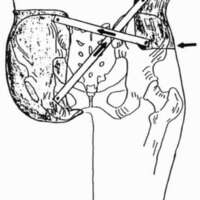 http://www.oandplibrary.org/cpo/images/1988_03_114/1988_03_114-4.jpg