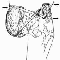 http://www.oandplibrary.org/cpo/images/1988_03_114/1988_03_114-5.jpg