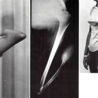 http://www.oandplibrary.org/al/images/1971_02_025/ArtificialLimbs-Autumn1971-37.jpg